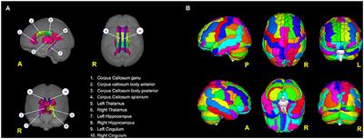 A Machine Learning Approach for the Differential Diagnosis of Alzheimer and Vascular Dementia Fed by MRI Selected Features